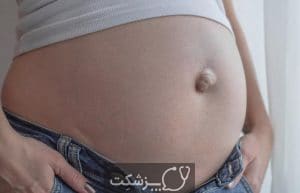 بیماری فتق- پزشکت