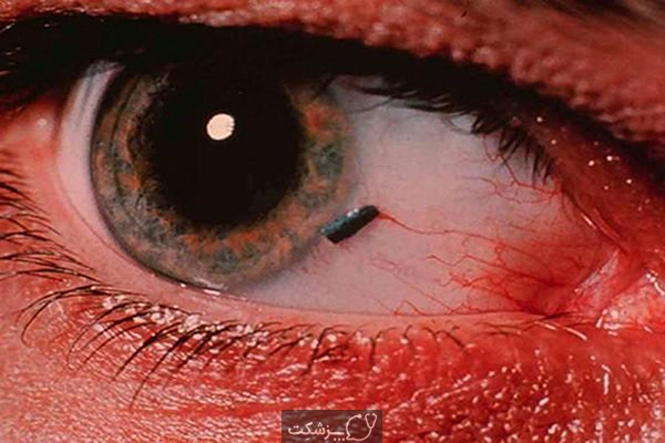 جسم خارجی در چشم | پزشکت