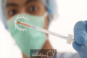 IUD ها | پزشکت