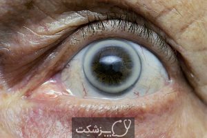 قوس پیری قرنیه | پزشکت