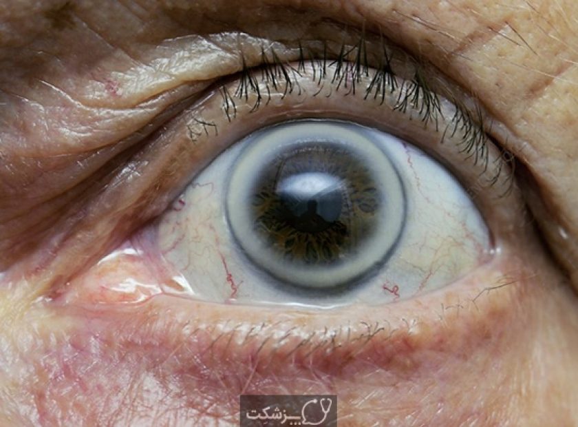 Arcus senilis disorder of the eye