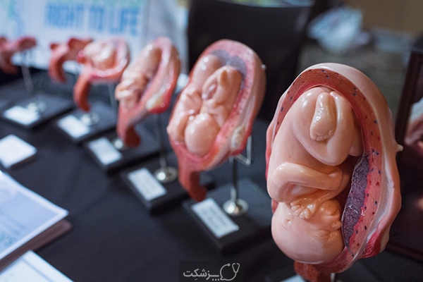 سقط جنین مکرر | پزشکت