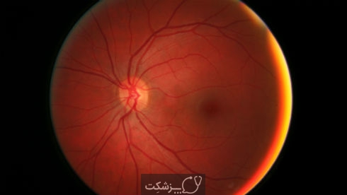 التهاب عصب بینایی | پزشکت