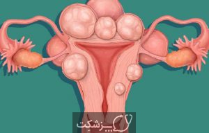 فیبروم رحمی | پزشکت