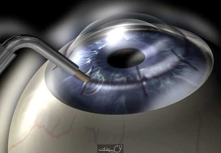 کراتوپلاستی هدایتی | پزشکت