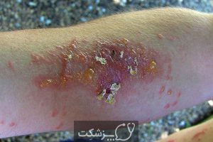 ضایعات پوستی ناشی از پیچک سمی | پزشکت