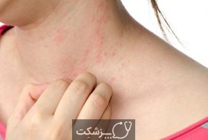 آلرژی نیکل | پزشکت