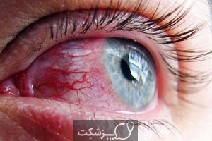 اختلالات چشمی | پزشکت
