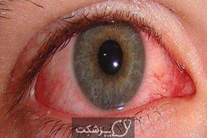 اختلالات چشمی | پزشکت