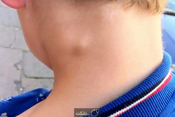 لنفوم | پزشکت