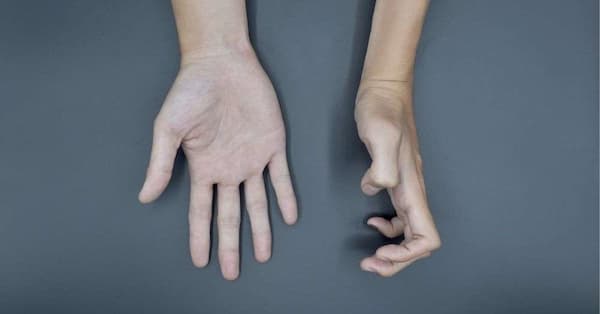 فلج دست بعد از سکته-پزشکت