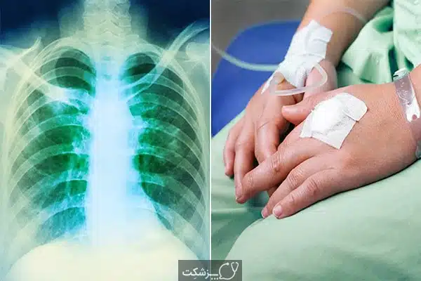لنفوم | پزشکت