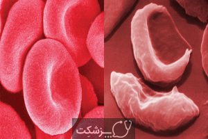 کم خونی سلول داسی | پزشکت
