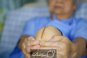 تعویض مفصل زانو | پزشکت