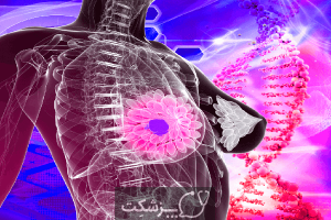 سرطان پستان | پزشکت