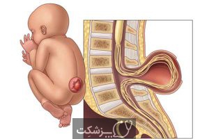 اسپینا بیفیدا | پزشکت