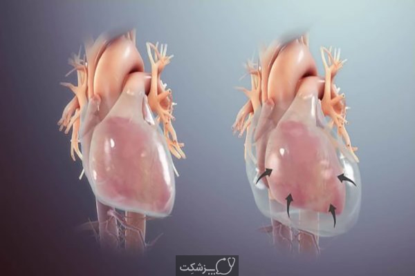 مایعات دور قلب | پزشکت