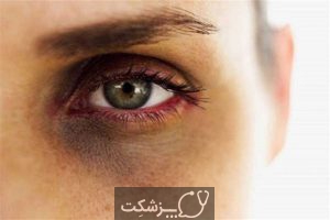 کبودی دور چشم | پزشکت