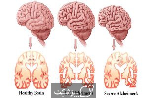 مراحل بیماری آلزایمر | پزشکت