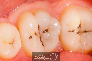 عصب کشی دندان | پزشکت