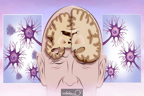 مراحل بیماری آلزایمر | پزشکت