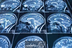 تومور کاذب مغزی | پزشکت