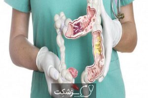 سرطان روده بزرگ | پزشکت