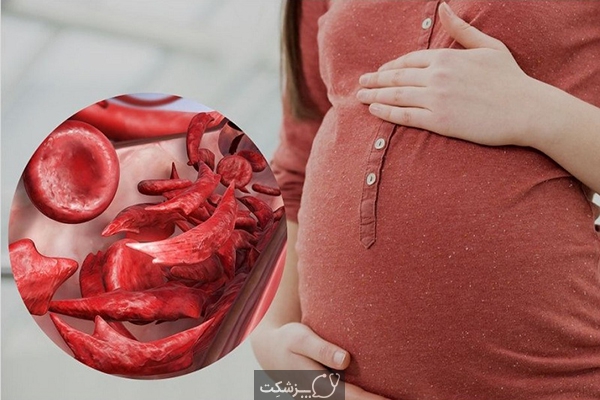 کم خونی در بارداری | پزشکت
