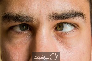 انحراف چشم | پزشکت