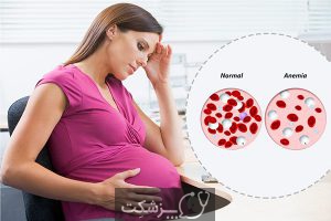 کم خونی در بارداری | پزشکت
