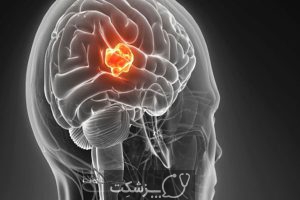 تومور مغزی | پزشکت