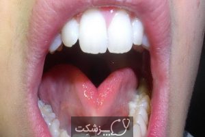 گره زبانی | پزشکت