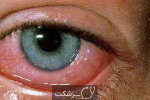 الرژی چشم | پزشکت