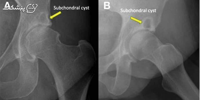 تصویر کیست استخوانی ساب کندرال در MRI-پزشکت
