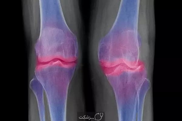 کیست استخوانی ساب کندرال -پزشکت