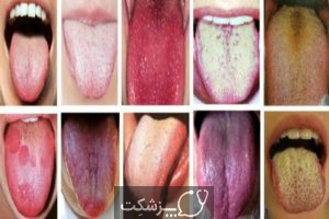 اختلالات شابع زبان | پزشکت
