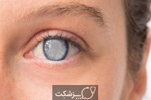 شایع ترین علت های درد چشم | پزشکت