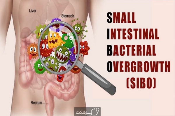 رشد باکتریایی روده کوچک (SIBO) | پزشکت