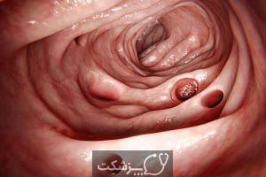 کولیت با غشای کاذب  | پزشکت