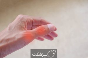 آرتروز انگشت شست | پزشکت