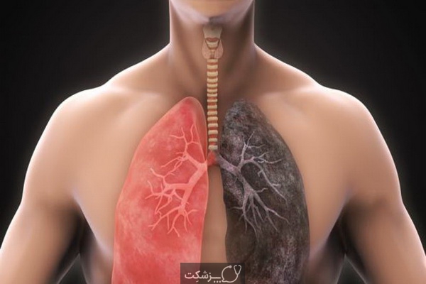 شایعترین علل بیماری های تنفسی | پزشکت