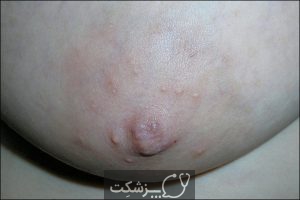 بیماری نوک پستان | پزشکت