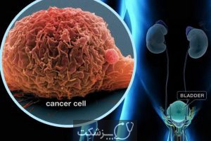 شایع ترین سرطان ها | پزشکت