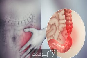 سندروم روده تحریک پذیر (IBS) | پزشکت