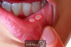 رابطه جنسی دهانی و عوارض آن | پزشکت