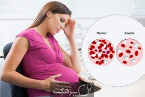 خون دماغ در بارداری | پزشکت