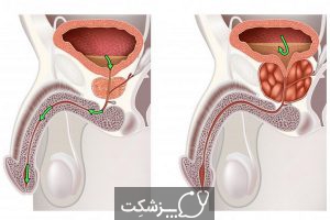 هایپرپلازی خوش خیم پروستات | پزشکت