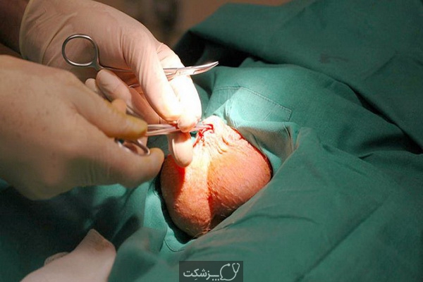جراحی عقیم سازی مردان | پزشکت