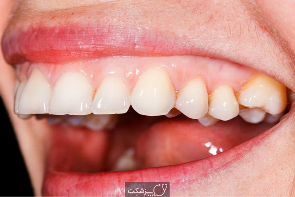 درمانهای خانگی سفید کردن دندان کدامند؟ | پزشکت