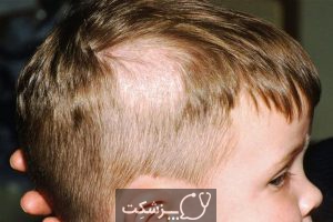 ریزش مو در کودکان | پزشکت